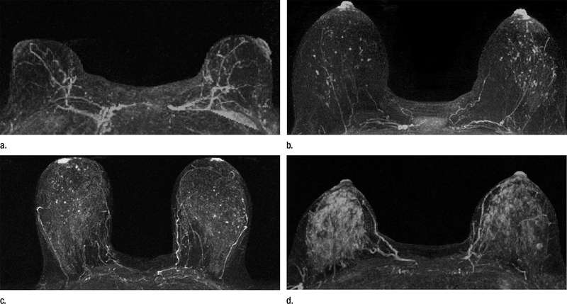 : These are examples of varying amounts of background parenchymal enhancement (BPE), as prospectively assessed qualitatively. Axial postcontrast maximum intensity .projection MR images show (a) minimal, (b) mild, (c) moderate, and (d) marked BPE. (Image: Radiological Society of North America)