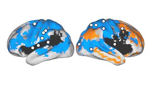 A new study shows stroke damage in patients mainly occurred in the black areas above. But the strokes also impaired brain networking nodes (white circles)  untouched by physical injury. Researchers say identifying these networking impairments will help better predict the challenges a recovering stroke patient is likely to confront. 