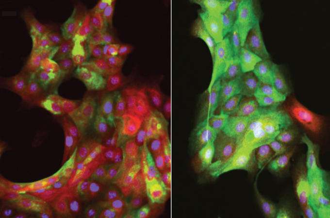 These fluorescent images of human mammary epithelial cells show the effects of aging. In the left image, multipotent progenitor cells from a 19-year-old woman respond to a tumor-mimicking stiff surface by differentiating into red-colored tumor-suppressing myoepithelial cells. In the right image, progenitor cells from a 66-year-old woman fail to launch this putative cancer-fighting response when exposed to a stiff surface. (Credit: Pelissier/LaBarge)