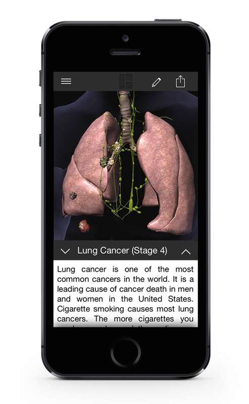 Looking at Stage 4 lung cancer on the BioDigital Human platform. Click pictures to view larger. (Image: Courtesy of BioDigital)