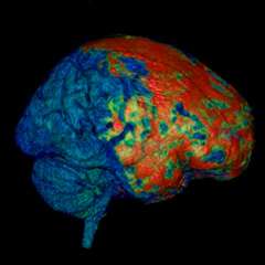 This 3-D MRI of a human brain reveals injury (in red) to the brain’s coverings following mild head trauma. (Source: NIH/Lawrence Latour, Center for Neuroscience and Regenerative Medicine)