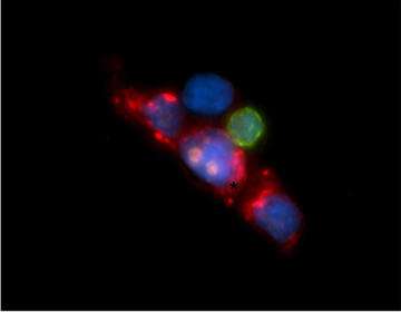 An earlier example of circulating tumor cells captured by a microfluidic isolation device. (Source: HMS/Mass General)