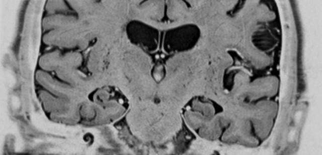 This is a coronal view of the hippocampus brain region of a patient with Alzheimer’s disease. (Source: University of Iowa/Daniel Tranel's laboratory)