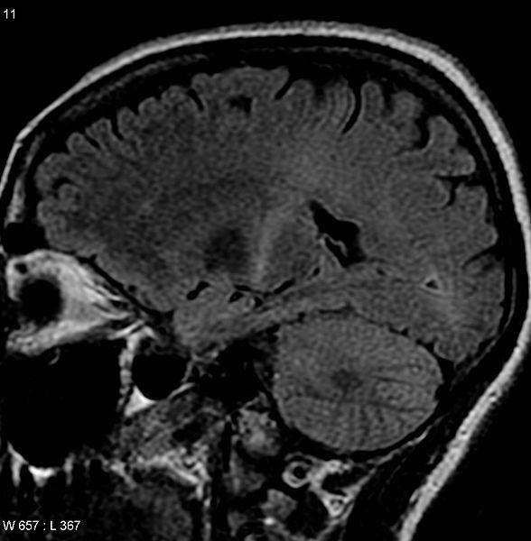 Amyotrophic lateral sclerosis MRI. (Source: Wikimedia/Frank Gaillard)