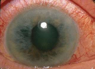 Photograph showing acute angle-closure glaucoma. (Source: Wikimedia/Jonathan Trobe, M.D.)