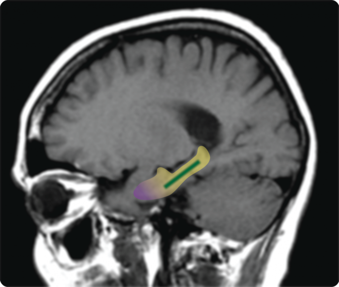 Brain area outlined in yellow is the hippocampus; the dentate gyrus is shown in green and the entorhinal cortex in purple. Previous work, including by the laboratory of senior author Scott A. Small, MD, had shown that changes in a specific part of the brain’s hippocampus—the dentate gyrus—are associated with normal age-related memory decline in humans and other mammals. The dentate gyrus is distinct from the entorhinal cortex, the hippocampal region affected in early-stage Alzheimer’s disease. (Source: CUMC/Scott A. Small, MD)