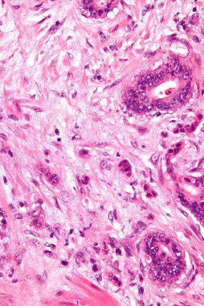 Micrograph showing tumor budding in colorectal carcinoma. (Source: Wikimedia/Nephron)