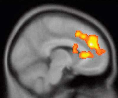 PET scans revealed that ketamine rapidly restored bipolar depressed patients’ ability to anticipate pleasurable experiences by boosting activity in the dorsal anterior cingulate cortex (yellow) and related circuitry. Picture shows PET scan data superimposed on anatomical MRI image. (Source: NIH)