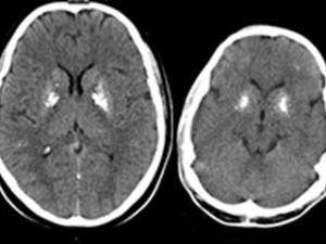 An unexpected link: Researchers found abnormal calcium deposits, a feature of certain autoinflammatory diseases, in the brains of all six patients who lack the immune protein ISG15. Above, the deposits appear as white spots in scans from two patients. (Source: Rockefeller University)