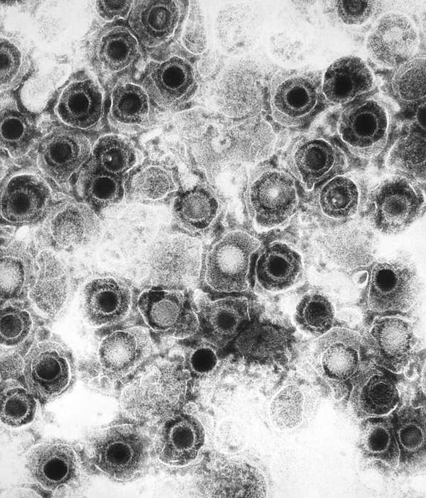 This negatively stained transmission electron micrograph (TEM) shows the presence of numerous herpes simplex virions. (Source: Wikimedia)