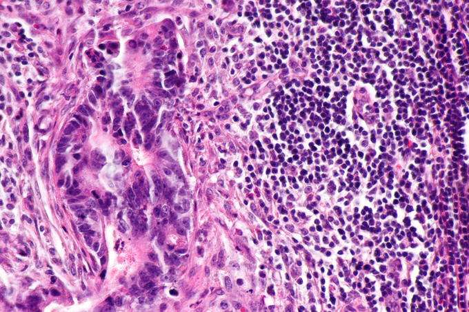 Micrograph of lymph node with colorectal carcinoma. H&E stain. (Source: Wikimedia/Nephron)