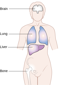 Common sites of metastasis for breast cancer (Source: Wikimedia)