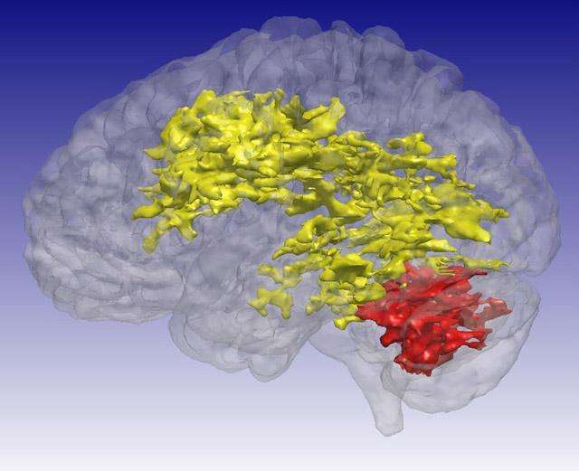 Using an MRI technique that is sensitive to certain byproducts of cell metabolism, including levels of glucose and acidity, University of Iowa researchers discovered previously unrecognized differences in the brains of patients with bipolar disorder. The T1rho MRI scans showed brain regions of elevated signal in the 15 participants with bipolar disorder compared to the 25 participants who did not have bipolar disorder. The primary regions of difference are the cerebral white matter (yellow) and the cerebellum (red). Art courtesy of UI Carver College of Medicine