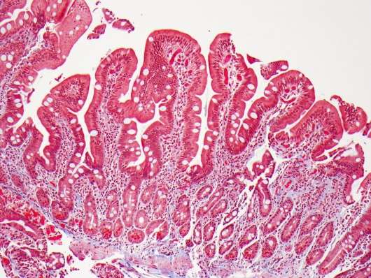 Biopsy of small intestine showing normal villi. (Source: CUMC/Govind Bhagat)