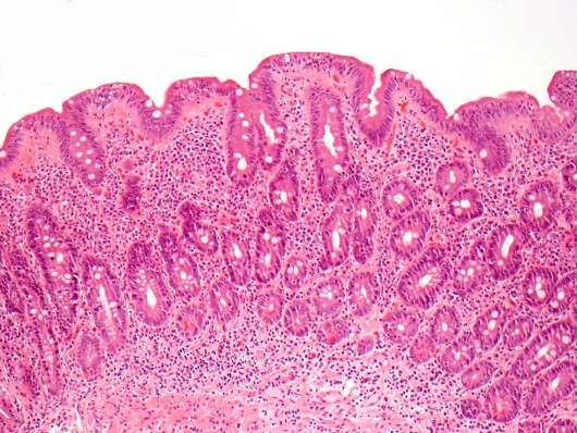 Biopsy of small intestine showing villous atrophy, i.e., flat villi. (Source: CUMC/Govind Bhagat)