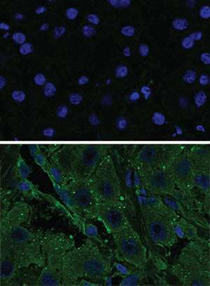 Images taken with a fluorescent microscope show the activity of a kinase (green) in tumor cells (bottom) compared to normal cells (top). (Source: The Rockefeller University)